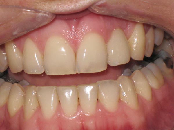 Restored dental implant on upper left incisor