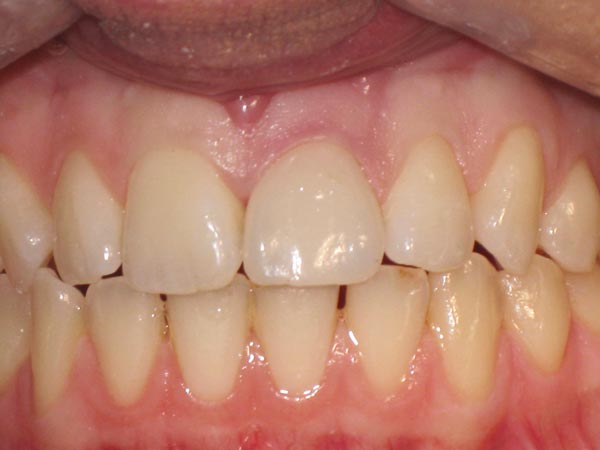 Ceramic crown on a central incisor